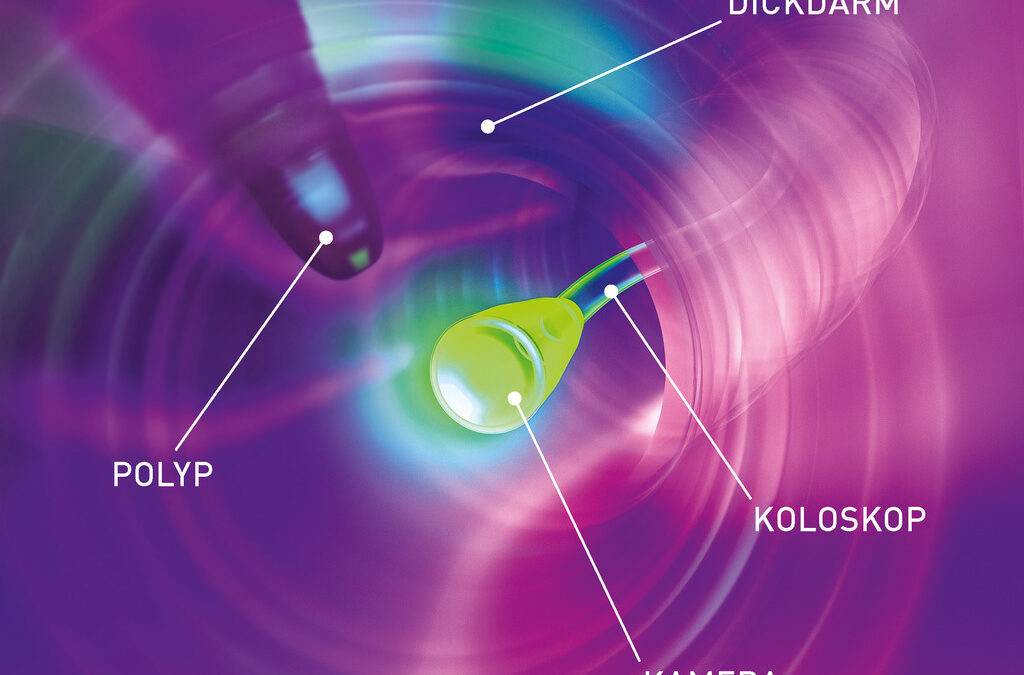 Grafik Polyp-Darmspiegelung-Koloskopie